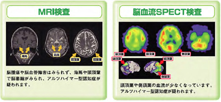 脳血流SPECT（スペクト）検査