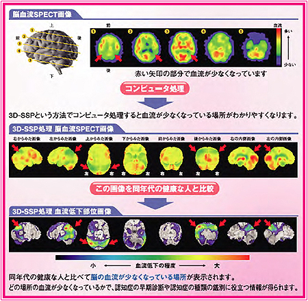 脳SPECT画像を3D-SSP