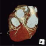 CT冠動脈