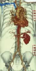 CT胸腹部大動脈